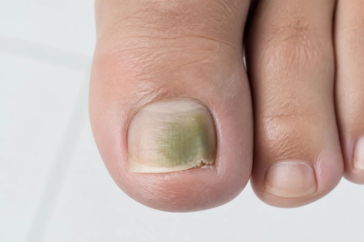 moisissure ongle vert traitement
