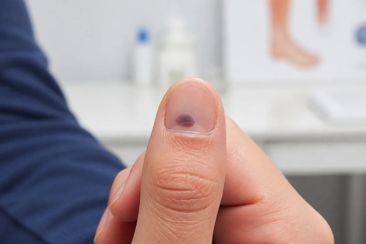 ongle abîmé traumatisme