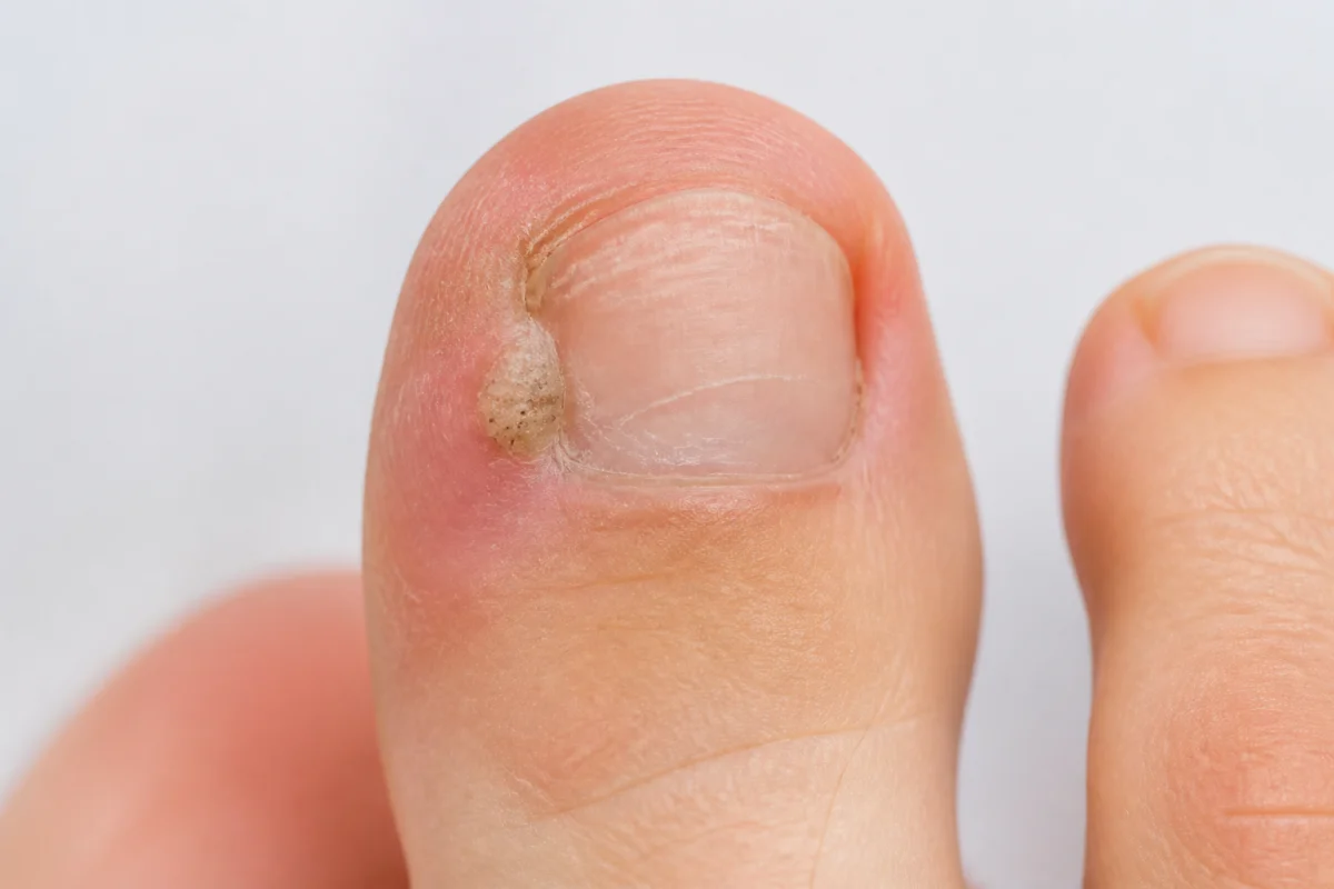 verrue ongle pied