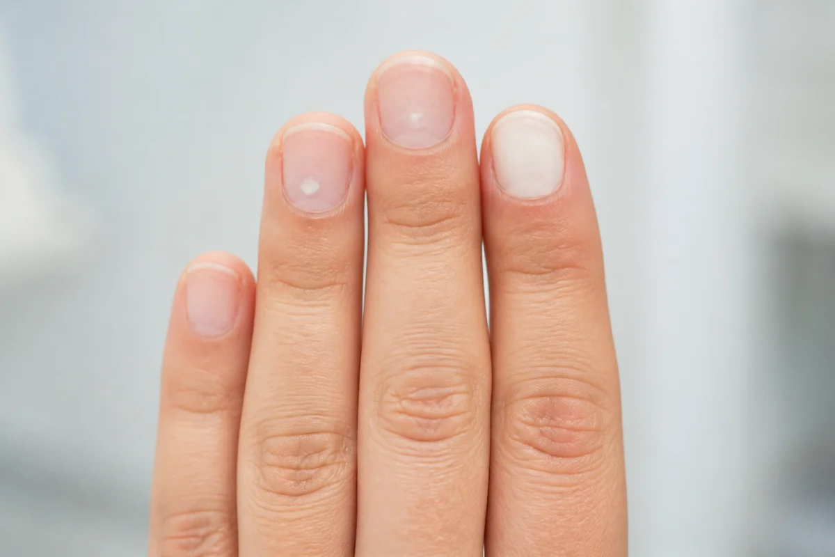 ongles blancs maladie
