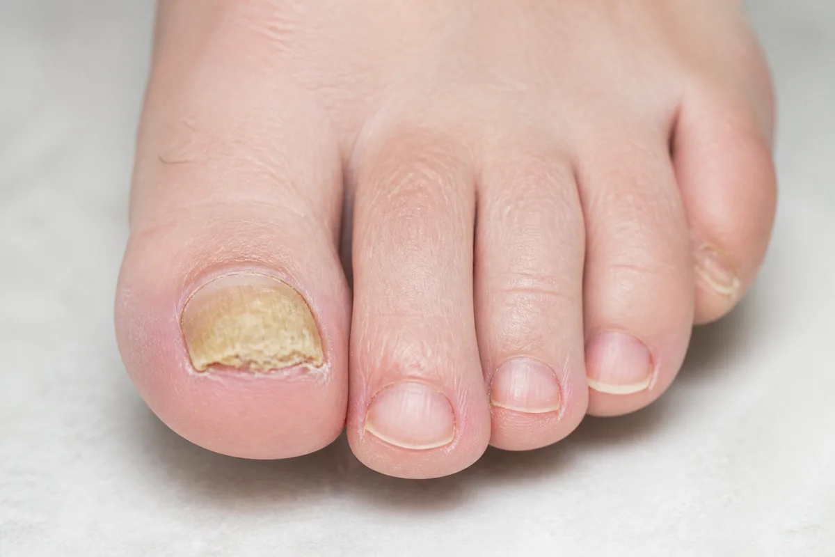 Douleur à l’orteil et à l’ongle comprendre les causes et réagir au bon moment